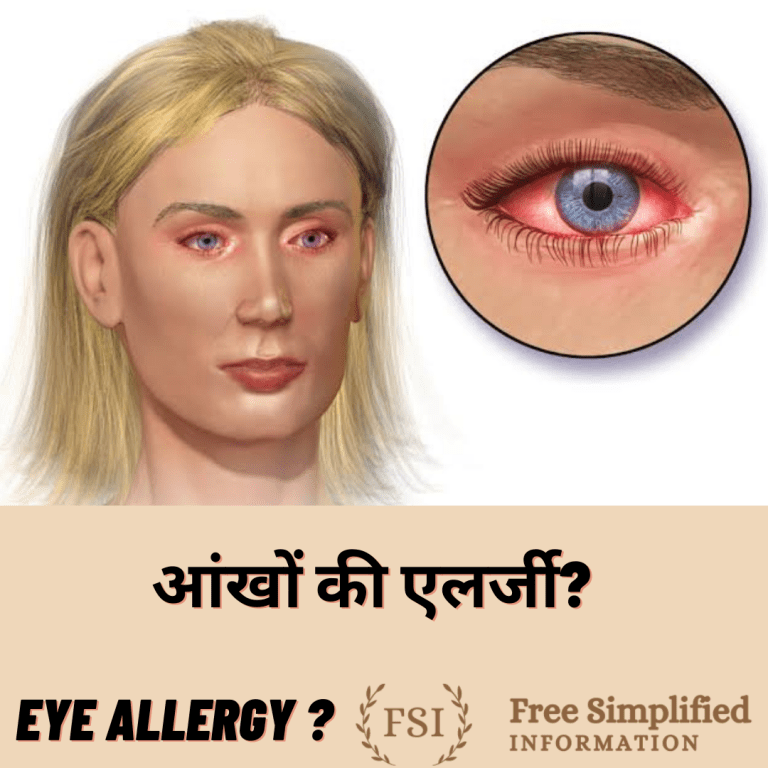 आंखों की एलर्जी ? allergy in eyes